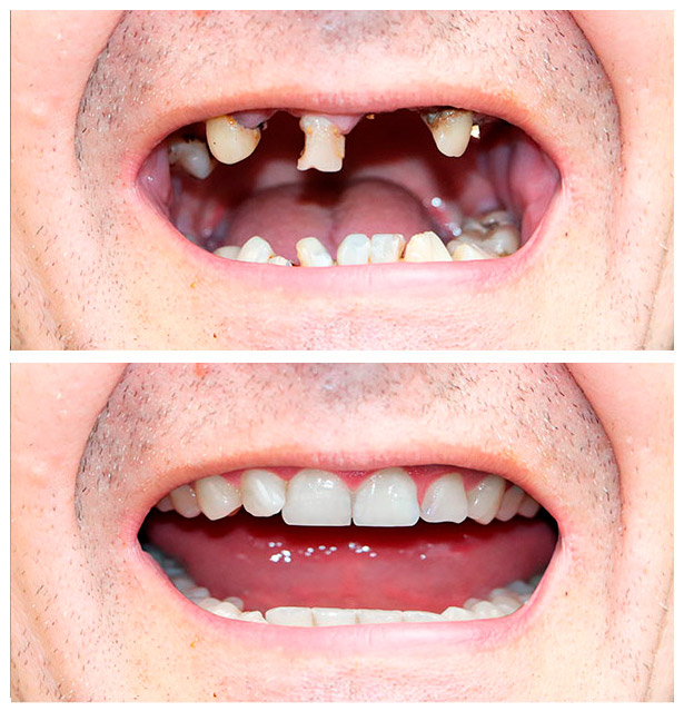 implantes dentales clínica orgaz dental usera