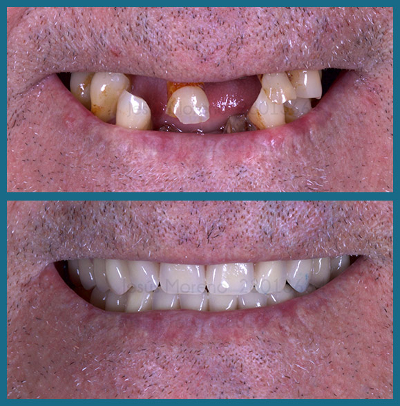 montaje fotográfico de tratamiento de implantes dentales orgaz dental usera