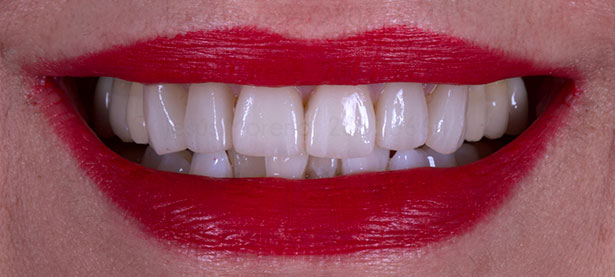 foto final Tratamiento mixto de implantes con carillas para mejorar la estética dental
