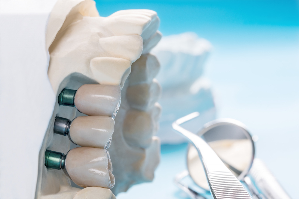 Claves del futuro de los implantes dentales