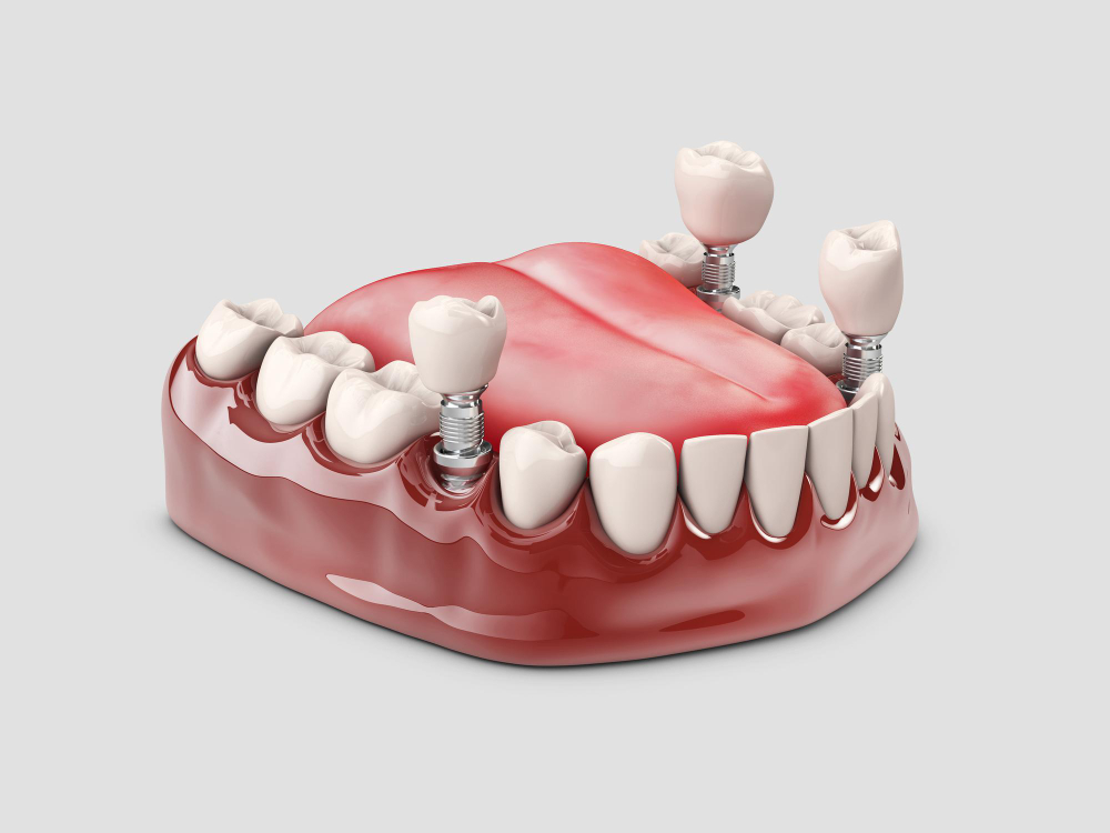 Los cambios novedosos de los implantes dentales