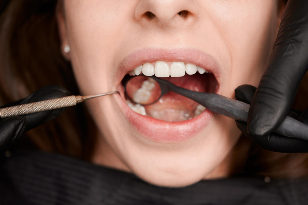 amalgamas dentales