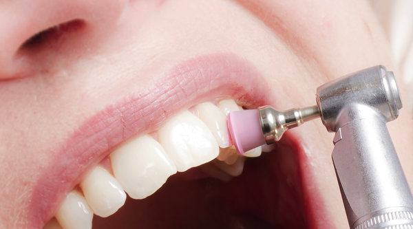 senales de que necesitas limpieza dental profesional