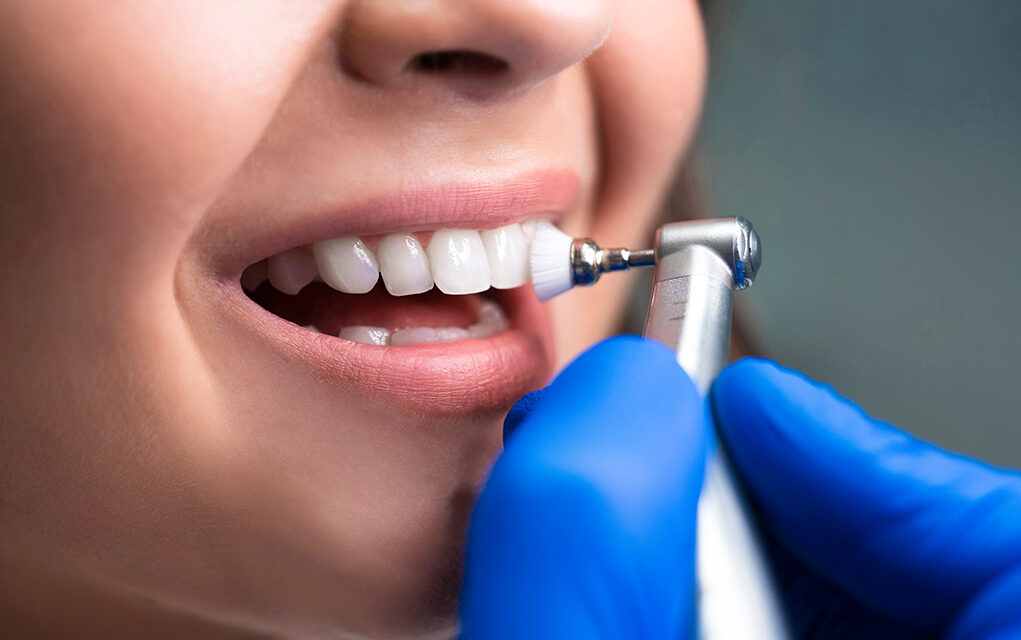 senales de que necesitas una limpieza dental profesional