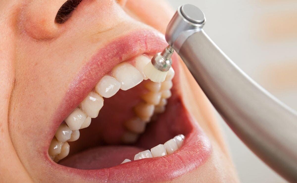 señales que necesitas una limpieza dental profesional