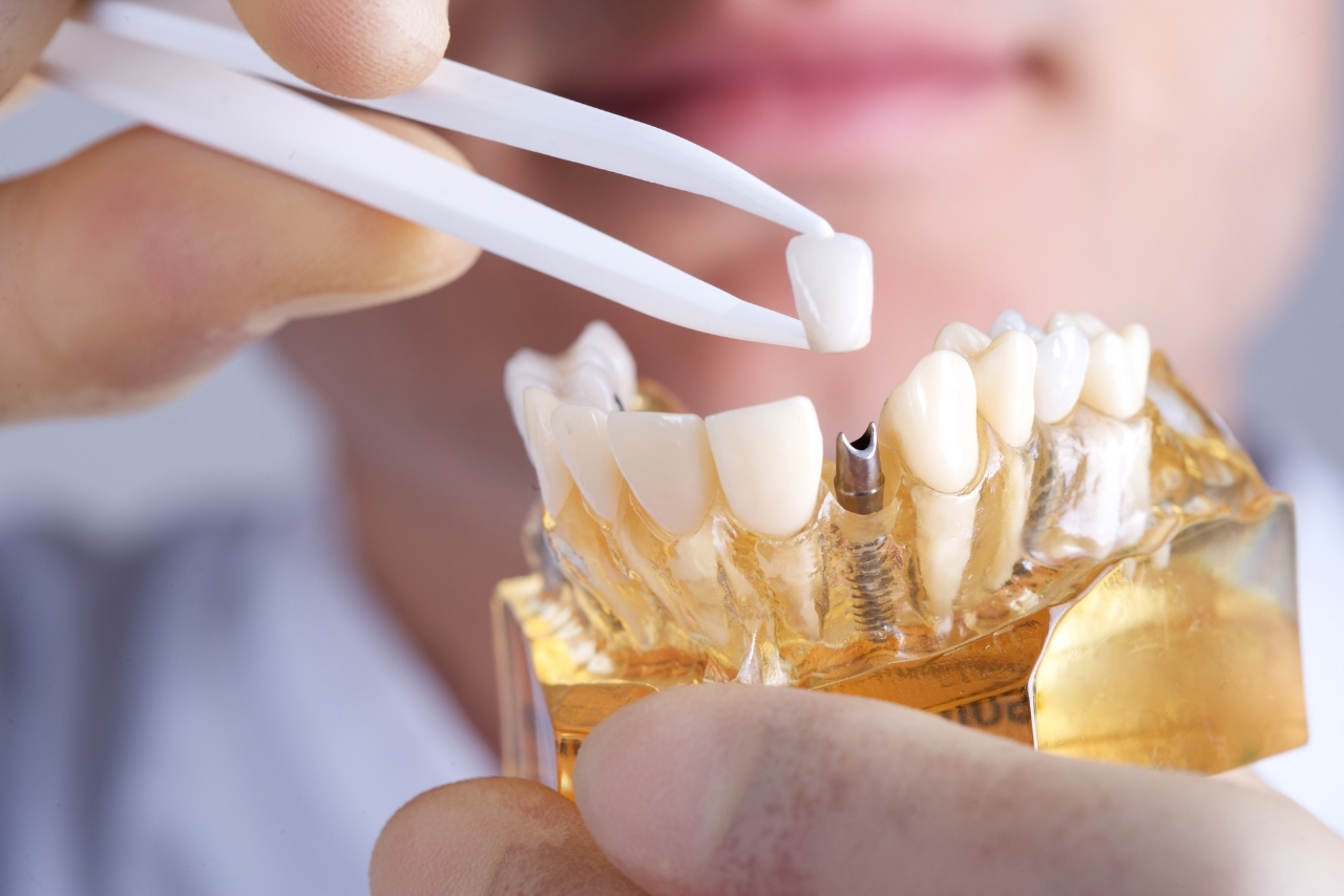 Implantes Dentales: Soluciones Fijas y Estéticas para Dientes Perdidos