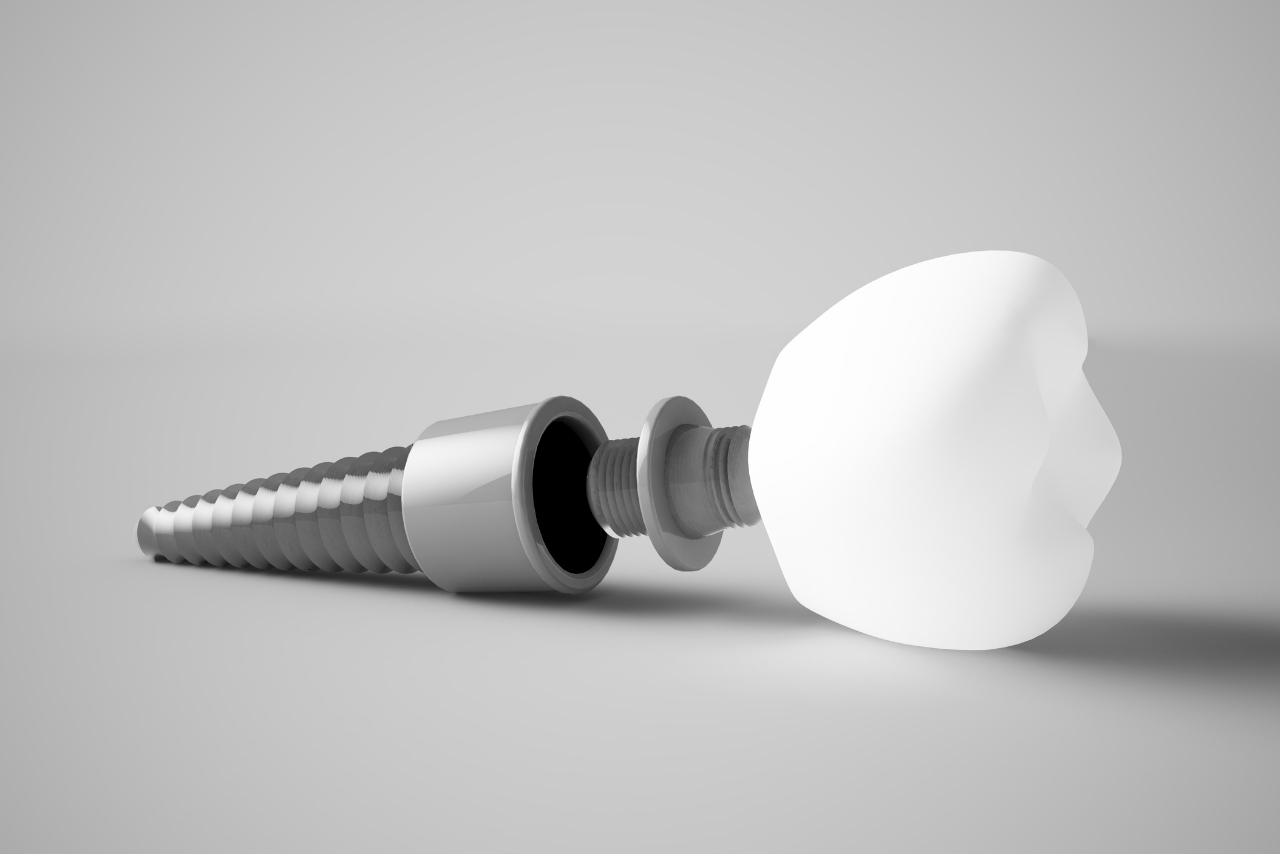 Implantes Dentales: Soluciones Fijas y Estéticas para Dientes Perdidos