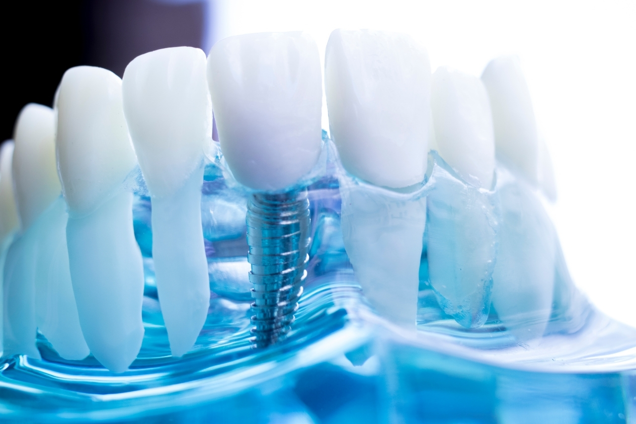 Implantes Dentales: Soluciones Fijas y Estéticas para Dientes Perdidos