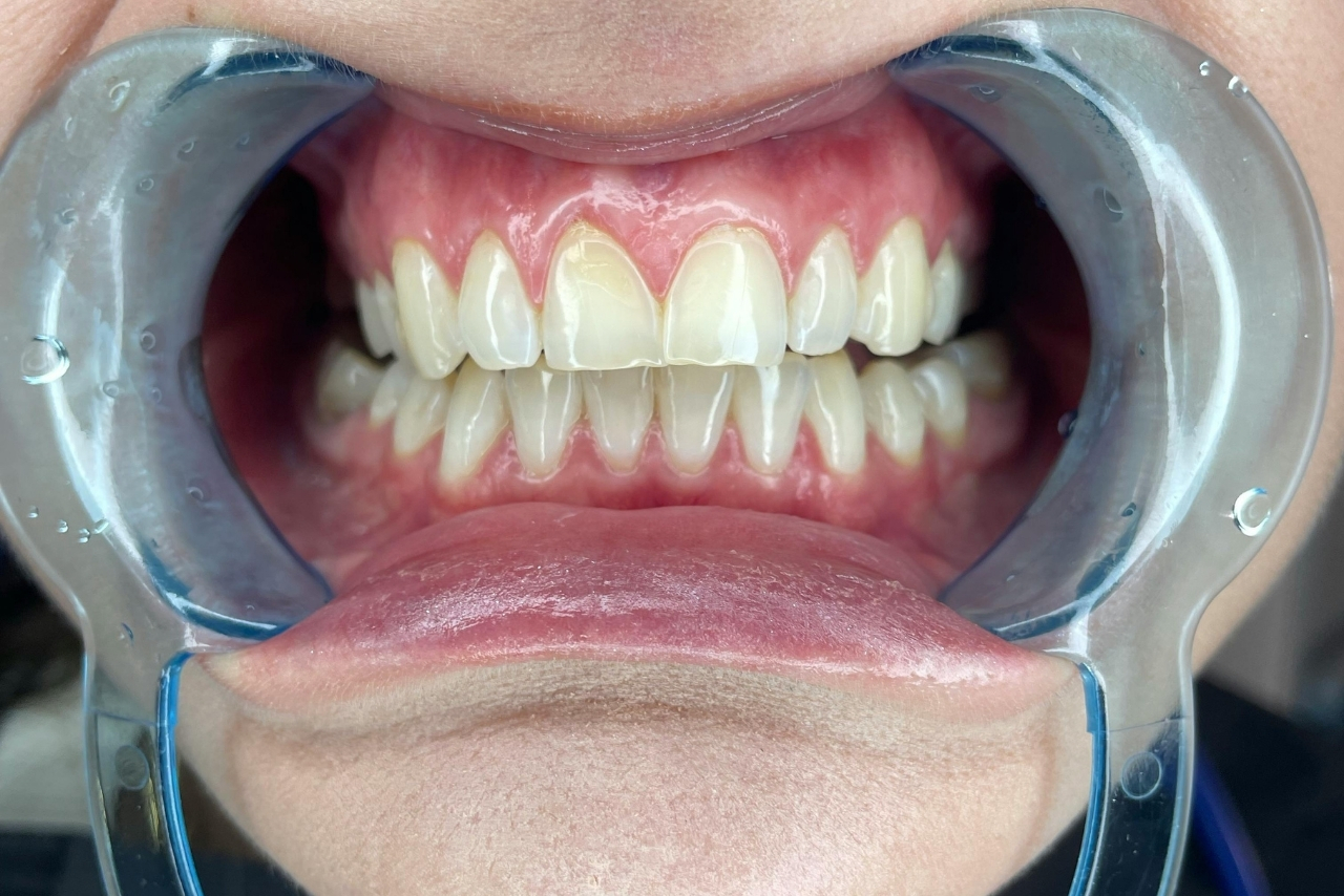 Blanqueamiento Dental Profesional