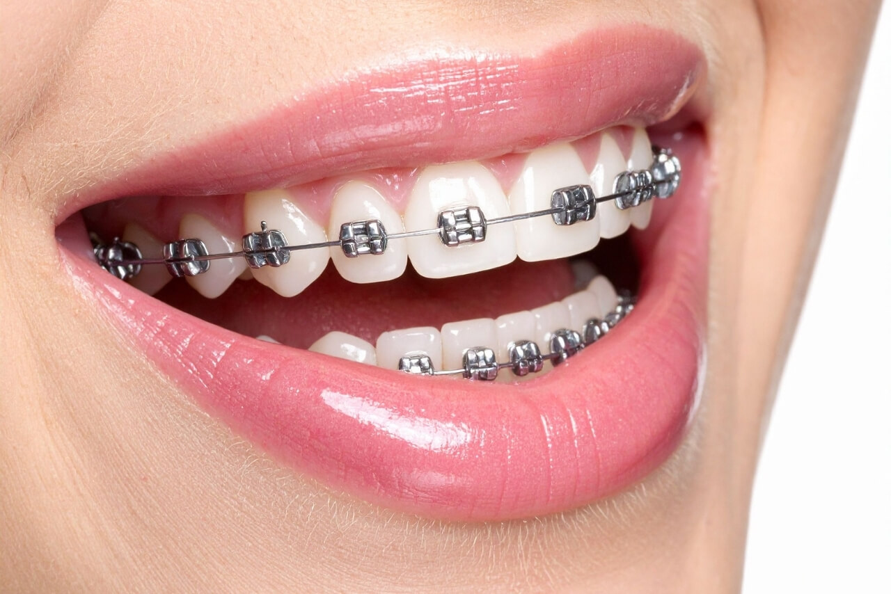 Ortodoncia con Brackets: Tipos, Proceso, Utensilios y Efectividad para Corregir Tu Sonrisa