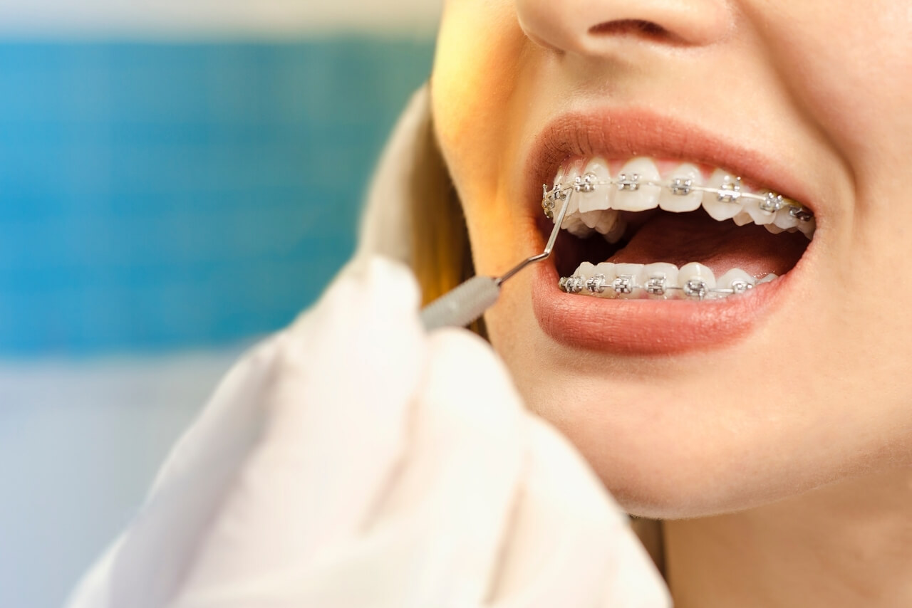 Ortodoncia con Brackets: Tipos, Proceso, Utensilios y Efectividad para Corregir Tu Sonrisa