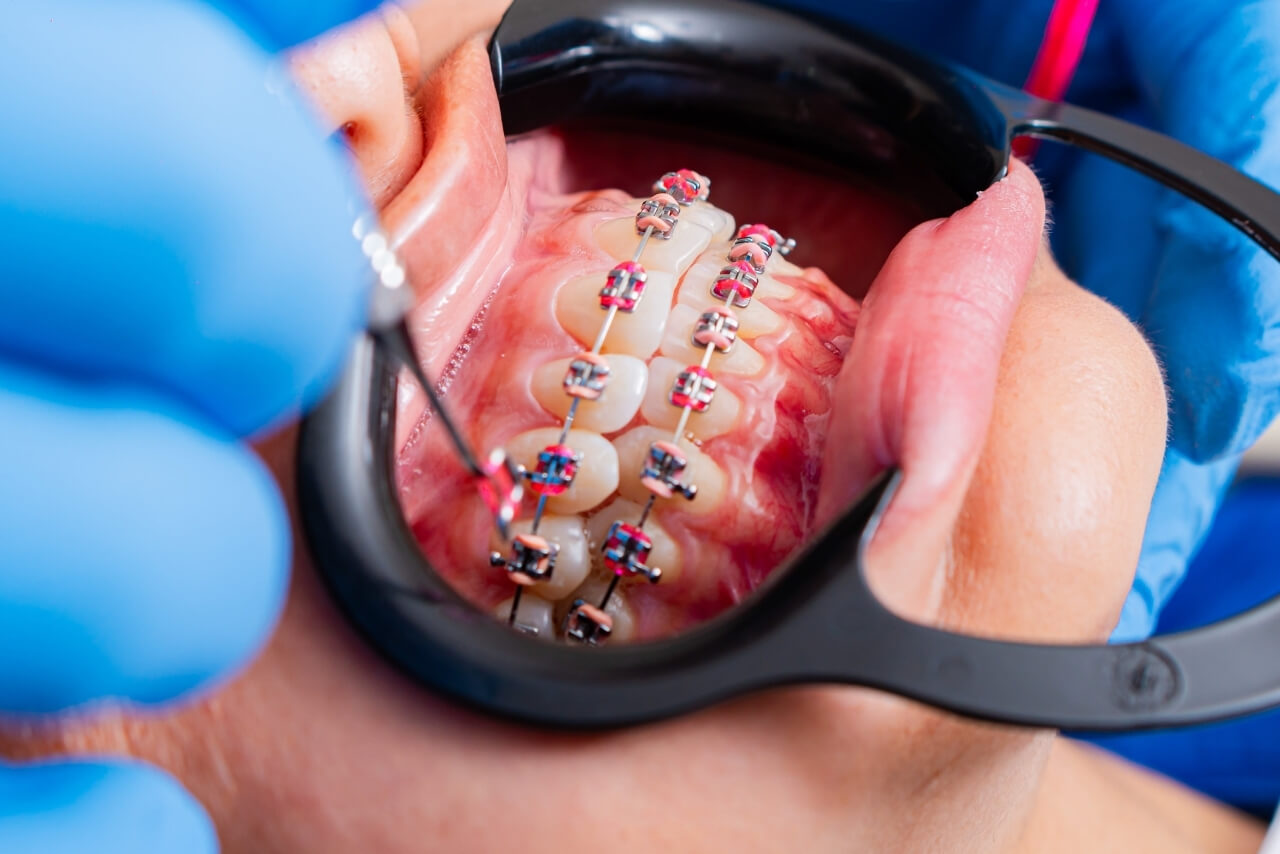 Ortodoncia con Brackets: Tipos, Proceso, Utensilios y Efectividad para Corregir Tu Sonrisa