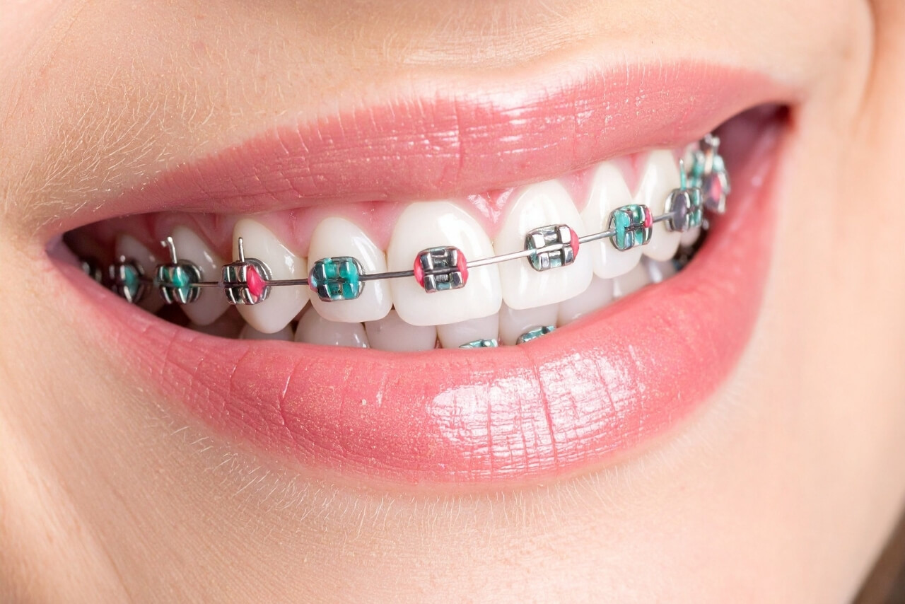Ortodoncia con Brackets: Tipos, Proceso, Utensilios y Efectividad para Corregir Tu Sonrisa